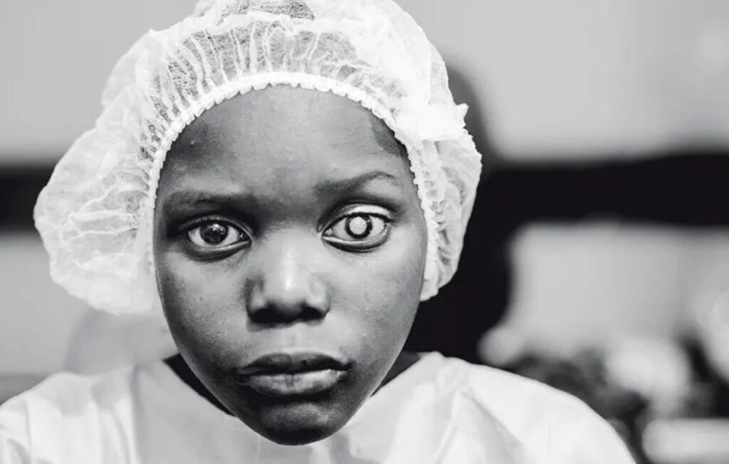 cataracte expo denis ponte