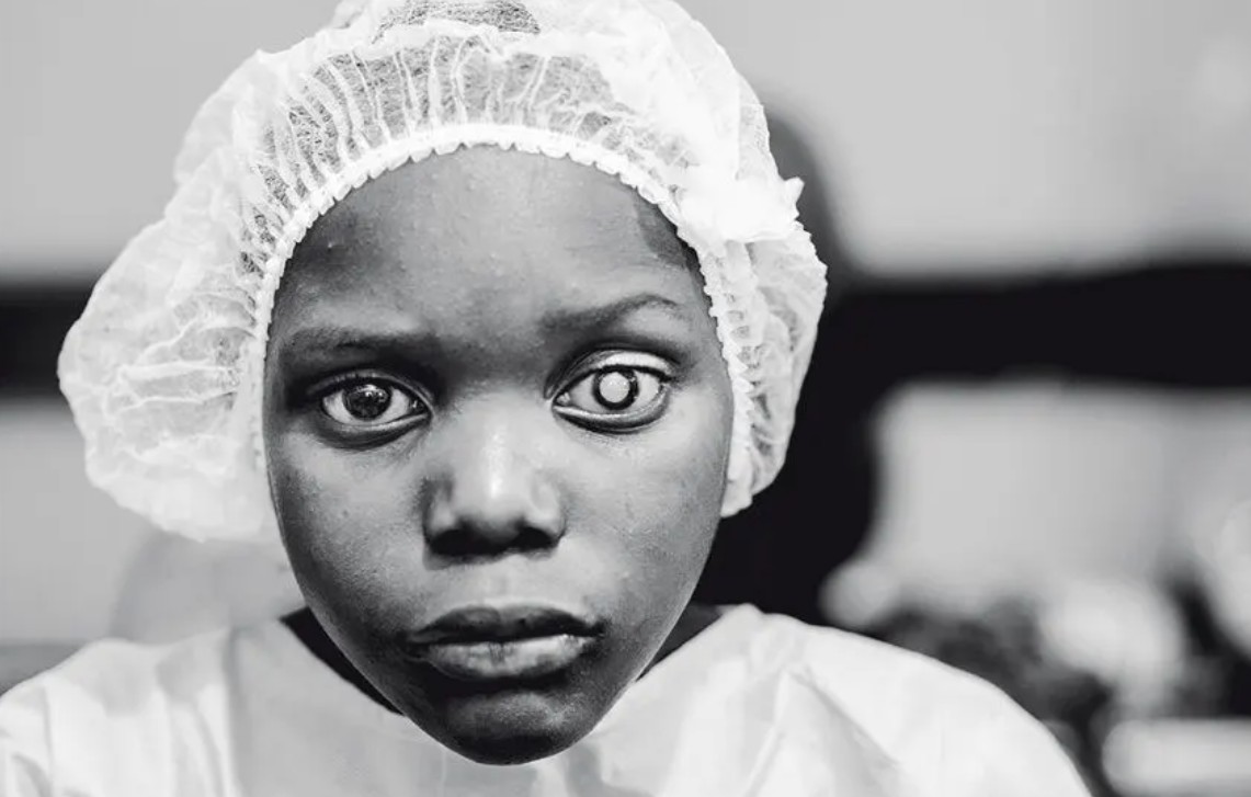 cataracte expo denis ponte